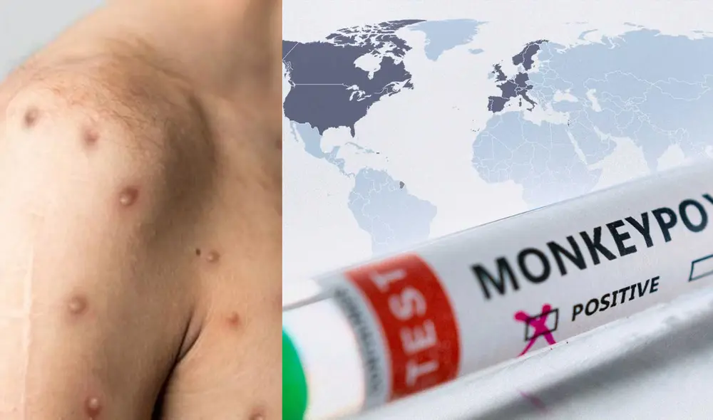 El virus del mono se está propagando por decenas de países del mundo. FOTO: RTVE/Shutterstock