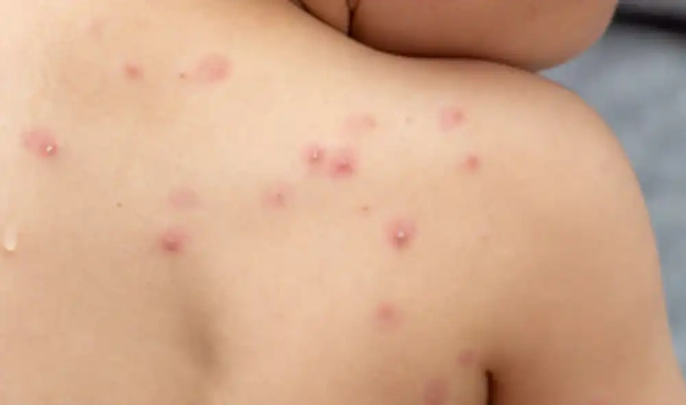 La principal característica de la Viruela del Mono son las erupciones de la piel. FOTO: AS Chile