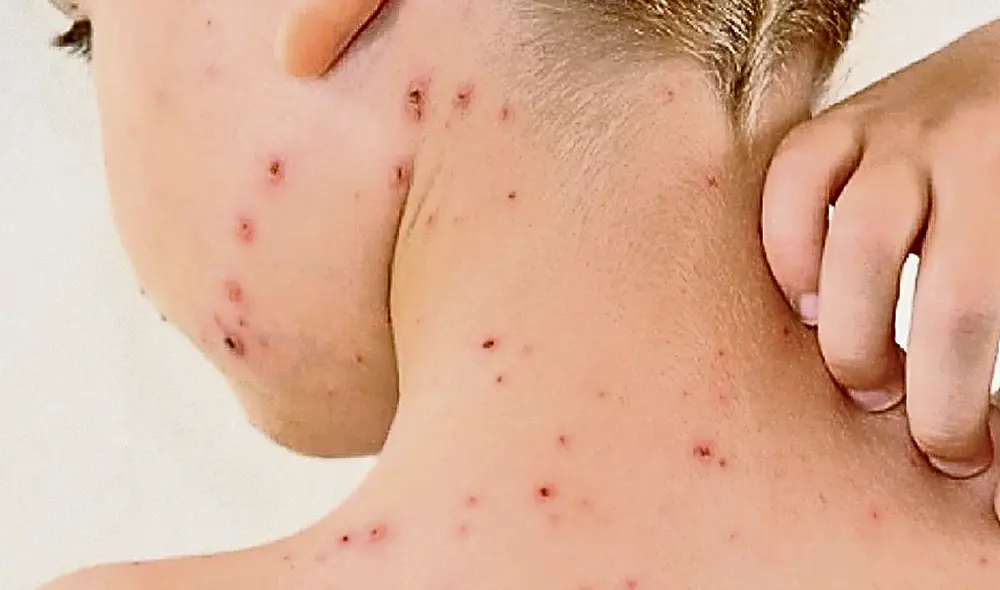 Proceso. Las erupciones en la piel es otro de los síntomas. El contagio es por contacto directo. Foto: difusión