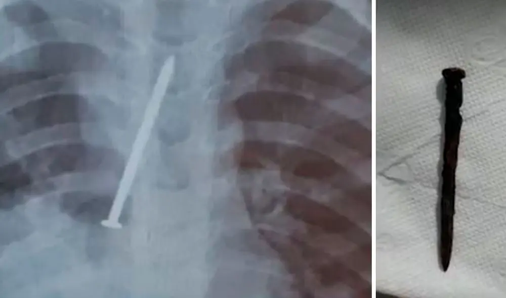 Padres tuvieron que pagar a un médico particular para que le hiciera un examen, el que evidenció el clavo incrustado en los pulmones. Foto: composición LR / captura g1.globo Padres tuvieron que pagar a un médico particular para que le hiciera un examen, el que evidenció el clavo incrustado en los pulmones. Foto: composición LR / captura g1.globo