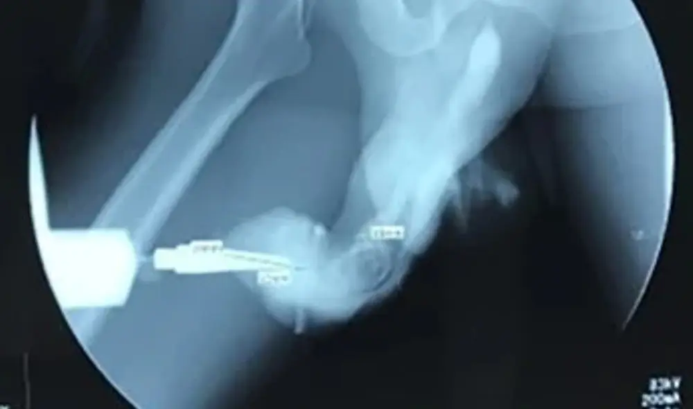 Radiografía del paciente. Foto: Clarin Radiografía del paciente. Foto: Clarin