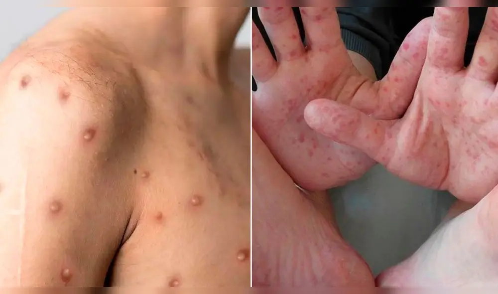 Para un adecuado seguimiento es importante diferenciar la viruela del mono de la enfermedad de manos, pies y boca. Foto: composición La República/El País/Vital Health Para un adecuado seguimiento es importante diferenciar la viruela del mono de la enfermedad de manos, pies y boca. Foto: composición La República/El País/Vital Health