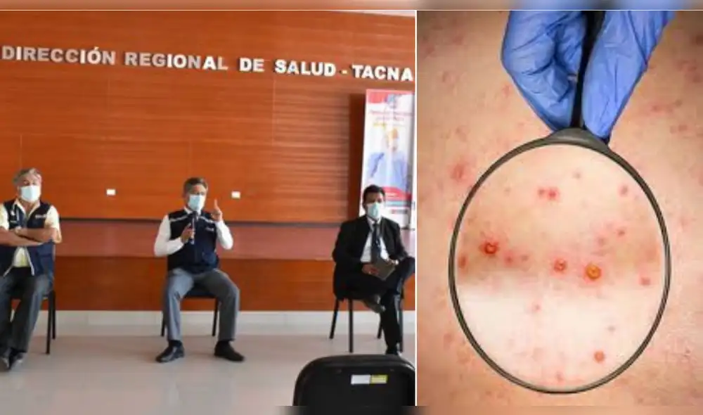 La Diresa Tacna afirmó que se encuentran preparados para atender los casos de viruela del mono que se presenten. Foto: La República/archivo