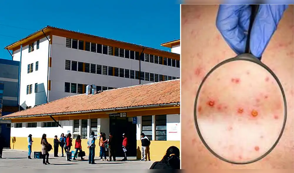 El sector salud exhorta a la población, que de tener síntomas como fiebre, ronchas y erupciones tipo ampollas en el cuerpo, entre otros, acudir a los establecimientos de salud. Foto: La República Archivo