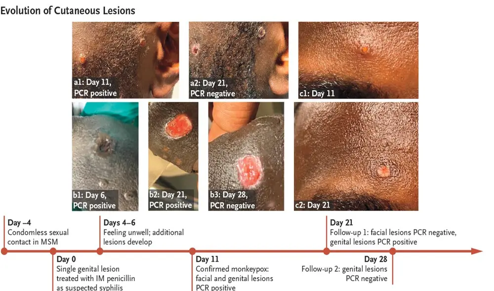 El estudio sobre nuevos síntomas de la viruela del mono fue publicado por The New England Journal of Medicine (NEJM) y dirigido por la Universidad Queen Mary de Londres. Foto: Nejm