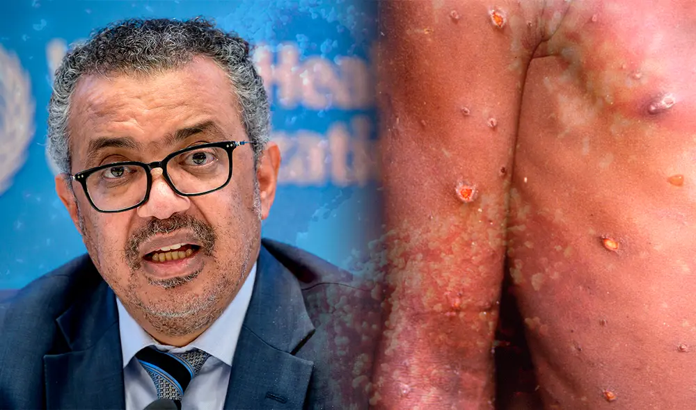 La OMS busca evitar que la viruela del mono termine como una pandemia. Foto: composición LR / AFP La OMS busca evitar que la viruela del mono termine como una pandemia. Foto: composición LR / AFP