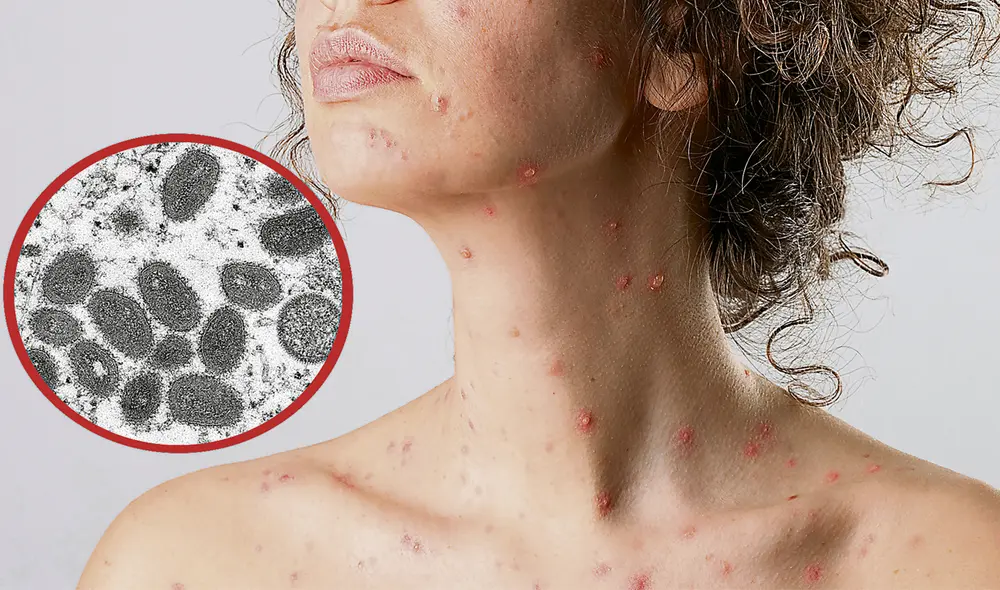 Cuidado. Contagio se da al hacer contacto con la piel de una persona infectada. Foto: difusión Cuidado. Contagio se da al hacer contacto con la piel de una persona infectada. Foto: difusión