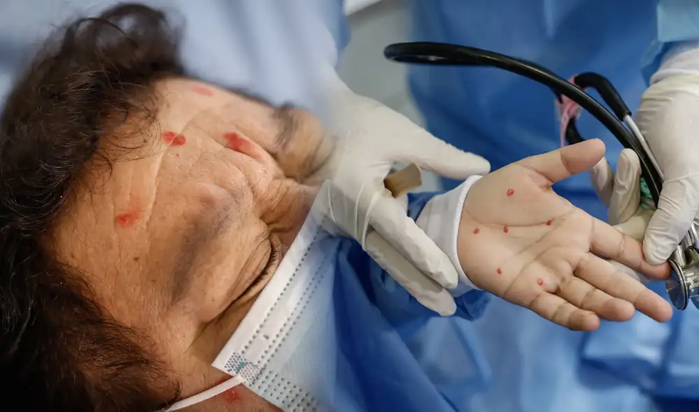 La enfermedad se ha extendido rápidamente por todo el Perú. Hasta el momento, no se han reportado muertes por la viruela del mono. Foto referencial: composición La República / Antonio Melgarejo Yaranga