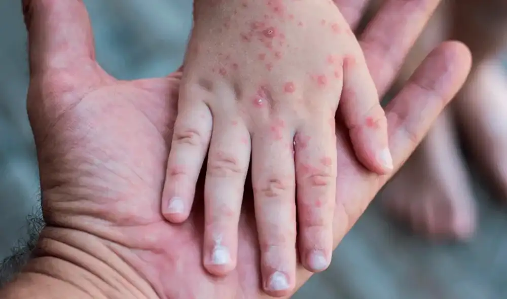 El primer caso se detectó el 17 de junio en un adulto joven de la Región Metropolitana, en Chile. Foto: EFE El primer caso se detectó el 17 de junio en un adulto joven de la Región Metropolitana, en Chile. Foto: EFE