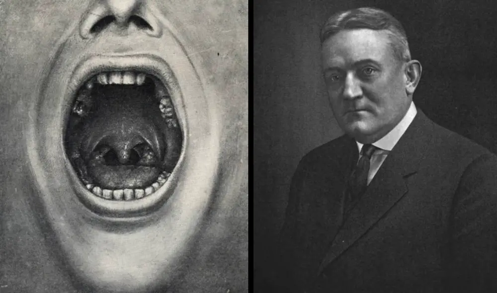 lustración de una boca con dientes extraídos del libro de Cotton. Foto: Composición LR/Wikipedia. lustración de una boca con dientes extraídos del libro de Cotton. Foto: Composición LR/Wikipedia.