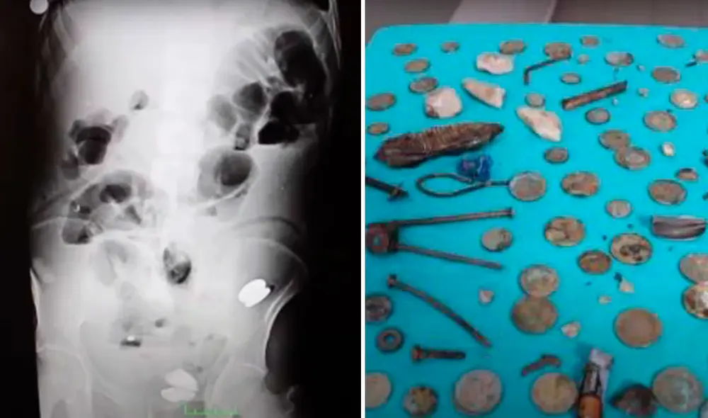 El paciente se recupera satisfactoriamente del lavado estomacal, pero no ha dado razón de cómo llegaron los 233 objetos a su estómago. Foto: FlashNews