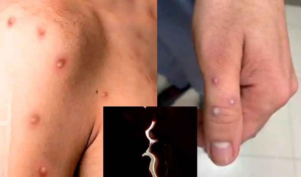 Una de las formas de transmisión de la viruela del mono es por besos, sexo oral o roces durante las relaciones. Foto: composición LR / Minsa Una de las formas de transmisión de la viruela del mono es por besos, sexo oral o roces durante las relaciones. Foto: composición LR / Minsa