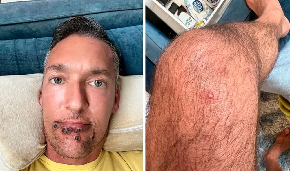 Silver Steele mostró fotografías de cómo luce al estar contagiado con la viruela del mono. Foto: Twitter/@TheSilverSteele Silver Steele mostró fotografías de cómo luce al estar contagiado con la viruela del mono. Foto: Twitter/@TheSilverSteele