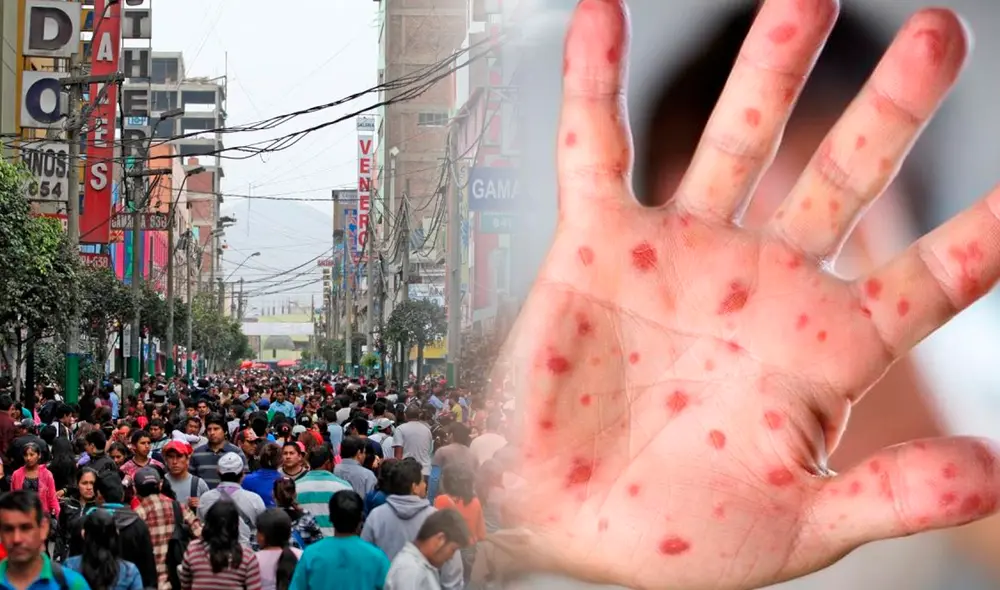 Perú es uno de los países más afectados en la región por la viruela del mono Foto: composición LR / Andina
