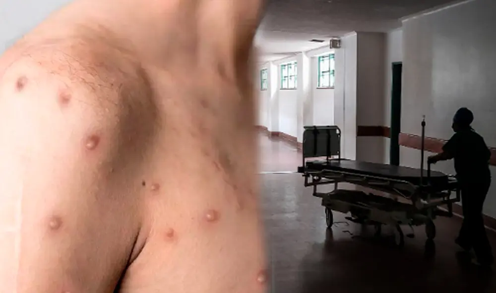 La OMS declaró a la viruela del mono como una emergencia internacional. Foto: Composición/LR/AFP