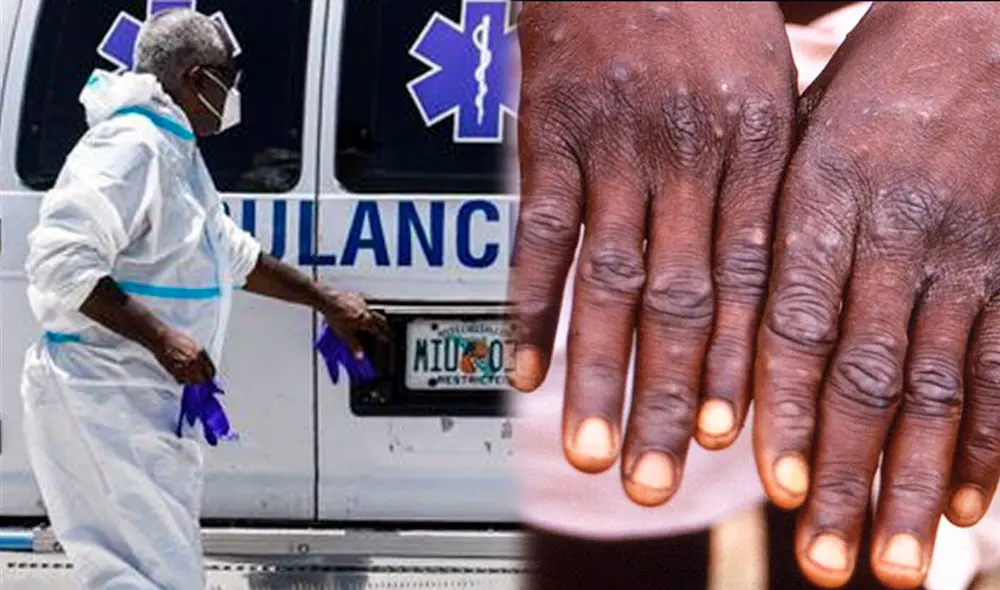 En España están confirmados 4.298 casos de viruela del mono hasta la fecha. Foto: composición/AFP/difusión