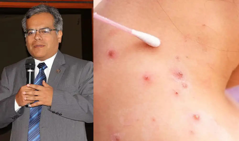 Jefe de la INS pide parar la estigmatización contra la población gay en el contagio de la viruela del mono. Foto: Composición La República/Perú Decide/Instagram/AFP