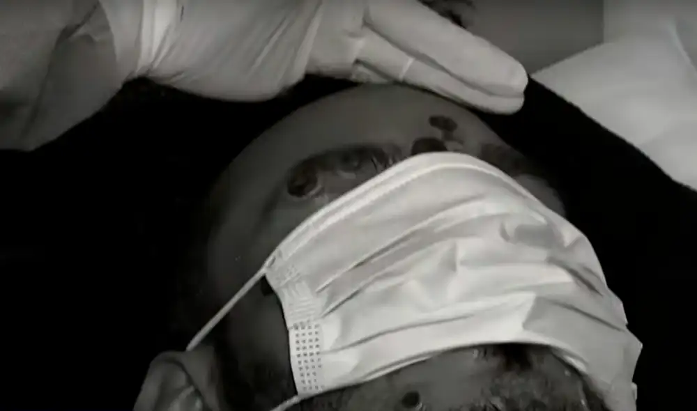 El Ministerio de Salud confirmó 305 casos de viruela del mono en Perú. Foto: captura de Latina