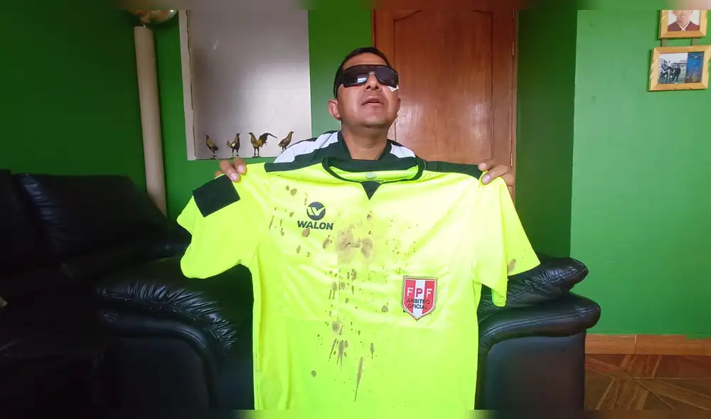 El árbitro fue diagnosticado con un traumatismo, hematoma y edema macular. Foto: Alexander Flores / URPI-LR El árbitro fue diagnosticado con un traumatismo, hematoma y edema macular. Foto: Alexander Flores / URPI-LR