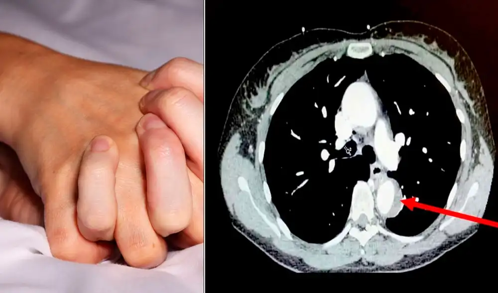 El dolor fue provocado por una lesión potencialmente mortal en la aorta, la arteria más grande y principal del cuerpo. Foto: composición LR/ American Journal of Case Reports