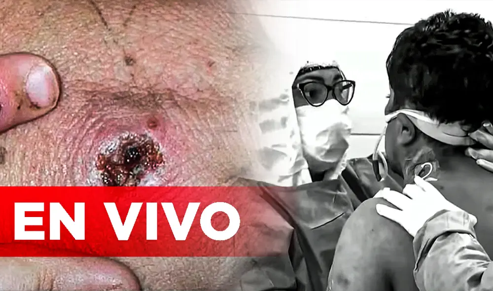 Revisa las últimas noticias sobre el desarrollo de la viruela del mono y la cuarta ola del coronavirus en Perú. Foto: composición LR/Minsa Revisa las últimas noticias sobre el desarrollo de la viruela del mono y la cuarta ola del coronavirus en Perú. Foto: composición LR/Minsa