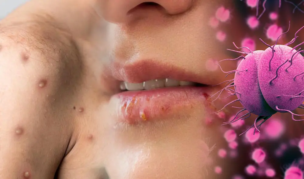 Los casos de la viruela del mono siguen en aumento y ya están en 12 regiones del país. Foto: composición Fabrizio Oviedo / La República