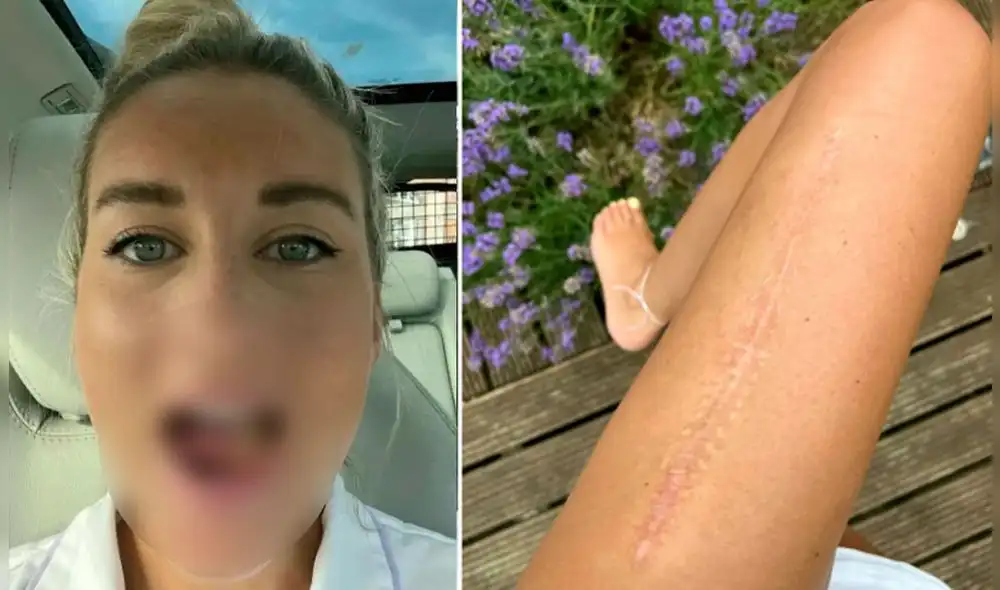 Tras ser sometida a una biopsia, los médicos le dijeron que el verdadero problema era un tumor canceroso llamado carcinoma de células escamosas. Foto: captura/Metro