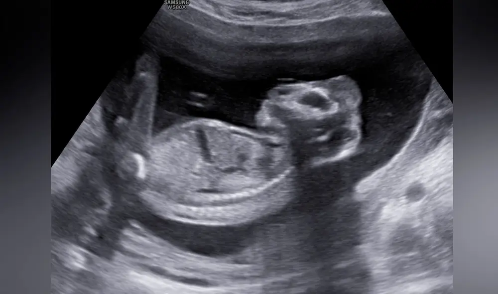 El diagnóstico de los médicos fue de una anencefalia, una malformación genética en el que el feto nace sin partes del encéfalo y el cráneo. Foto: Clínica Rosa Peñafiel