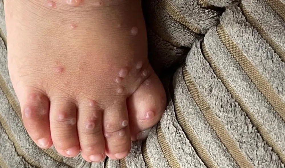 Erupciones cutáneas en un infante de 13 meses de edad, uno de los casos confirmados de "gripe del tomate". Foto: The Pediatric Infectious Disease Journal Erupciones cutáneas en un infante de 13 meses de edad, uno de los casos confirmados de "gripe del tomate". Foto: The Pediatric Infectious Disease Journal