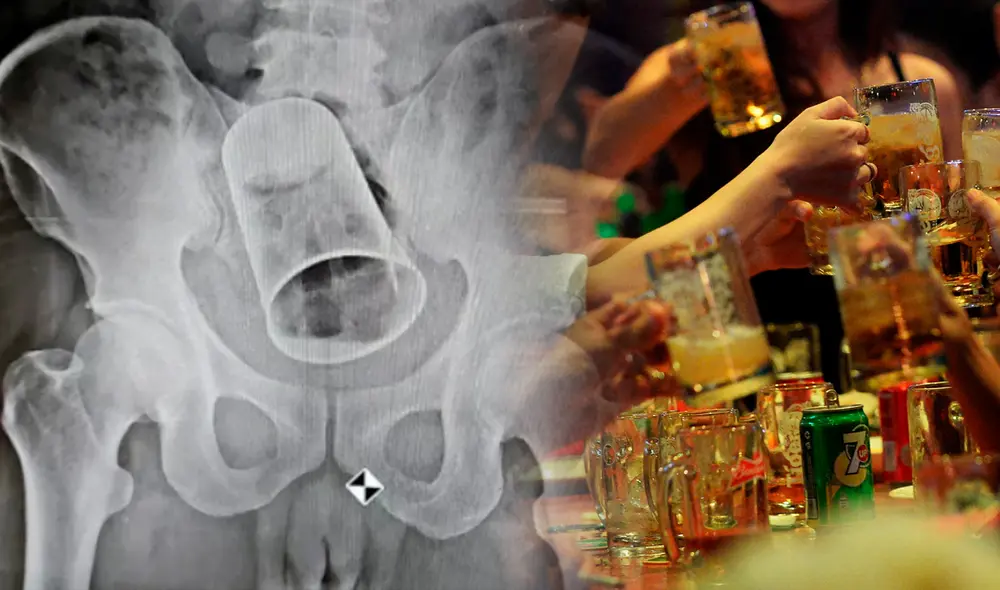 El hombre tuvo que ser operado de urgencia y le fue extraído el objeto metálico que le bloqueaba el recto impidiéndole evacuar las heces. Foto: Composición LR/Newslions/AFP. El hombre tuvo que ser operado de urgencia y le fue extraído el objeto metálico que le bloqueaba el recto impidiéndole evacuar las heces. Foto: Composición LR/Newslions/AFP.