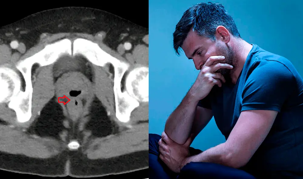 El equipo médico compartió el artículo para avisar a sus colegas de las posibles complicaciones que podría tener el catéter de Foley, aunque sea un caso insólito. Foto: composición LR/Cureus