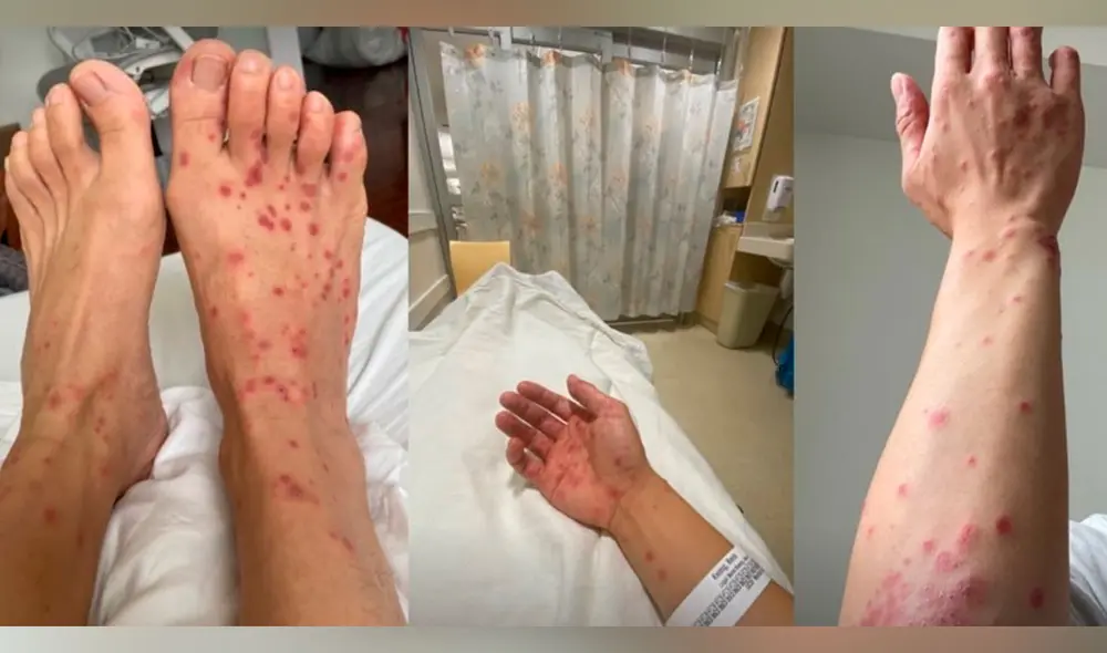 Al principio, Kwong trató la erupción con los esteroides tópicos que se utiliza para la dermatitis. Foto: Telemundo Al principio, Kwong trató la erupción con los esteroides tópicos que se utiliza para la dermatitis. Foto: Telemundo