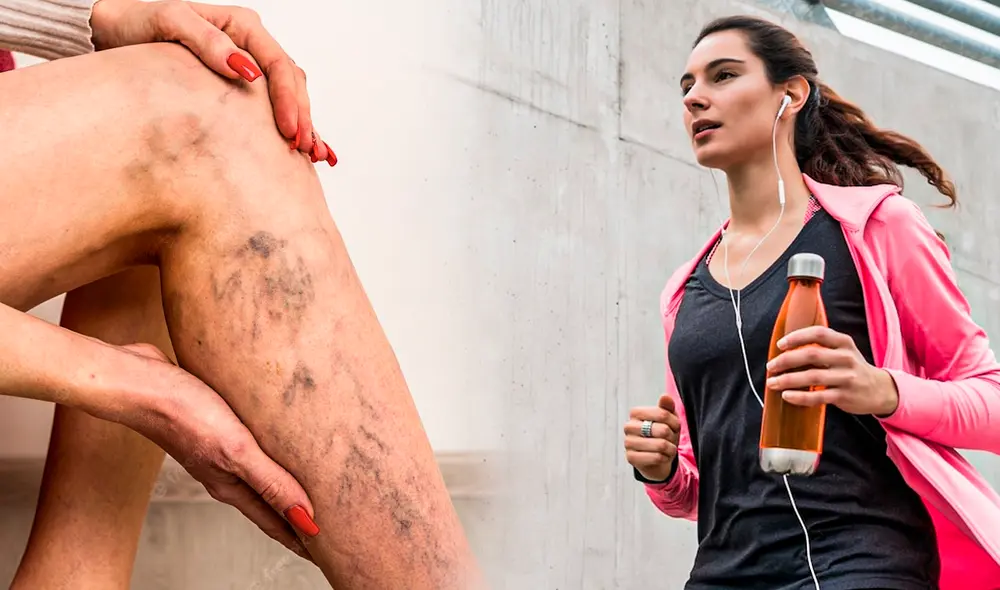 Llevar una vida sedentaria aumentará las posibilidades de desarrollar várices. Foto: composición de Jazmin Ceras / La República / Freepik