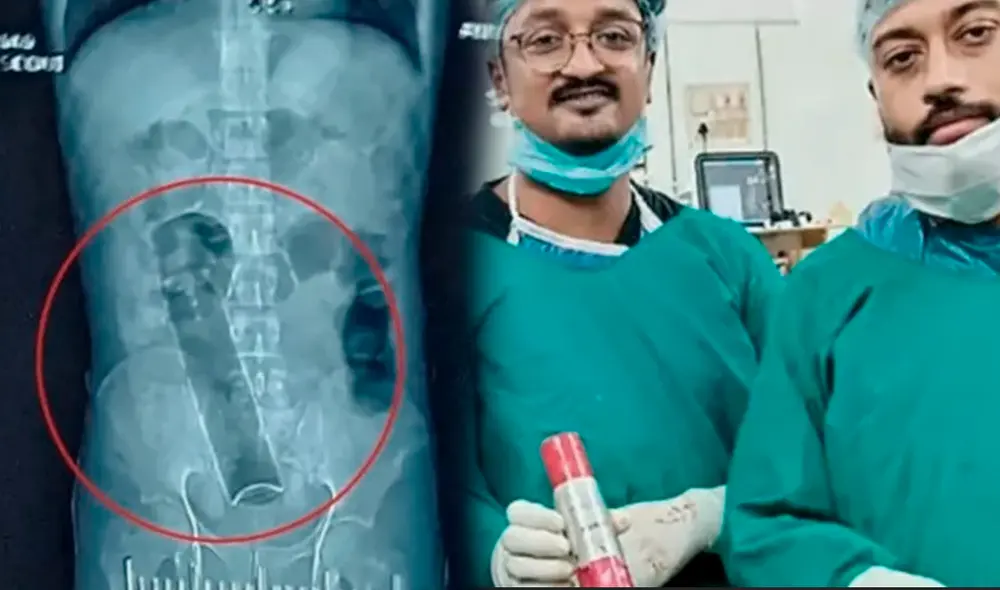 Objeto estuvo atorado durante tres semanas y pudo ser retirado por médicos de la India. Foto: Composición/LR/India's News18