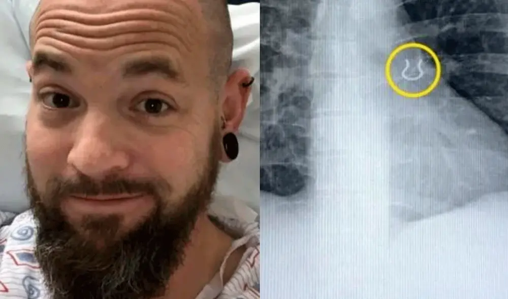 Joey Lykins fue sometido a una broncoscopía para removerle el piercing del pulmón izquierdo. Foto: Kennedy News and Media Joey Lykins fue sometido a una broncoscopía para removerle el piercing del pulmón izquierdo. Foto: Kennedy News and Media