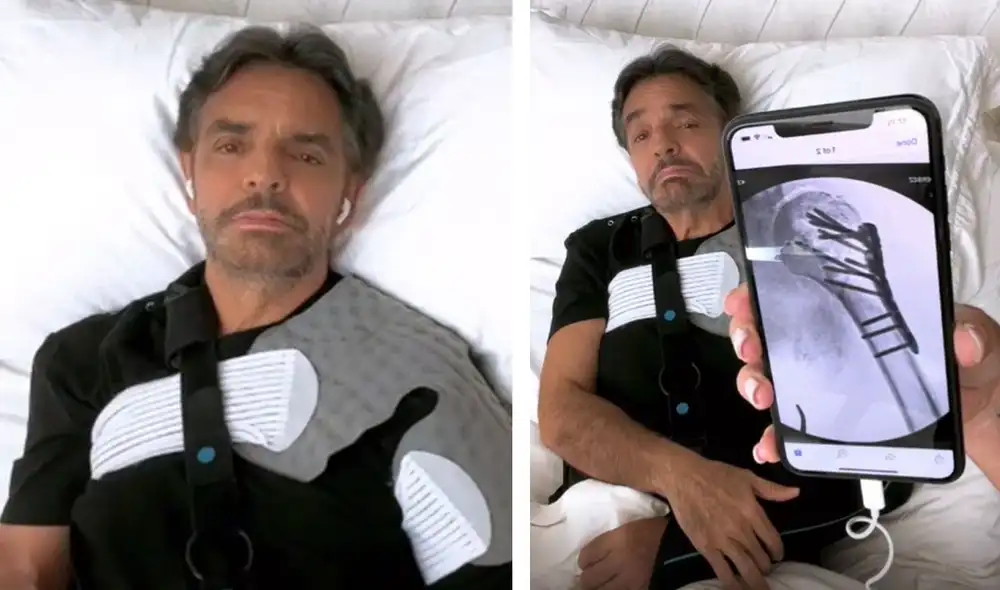 Eugenio Derbez apareció en Instagram para contar cómo se fracturó el brazo. Foto: captura Instagram