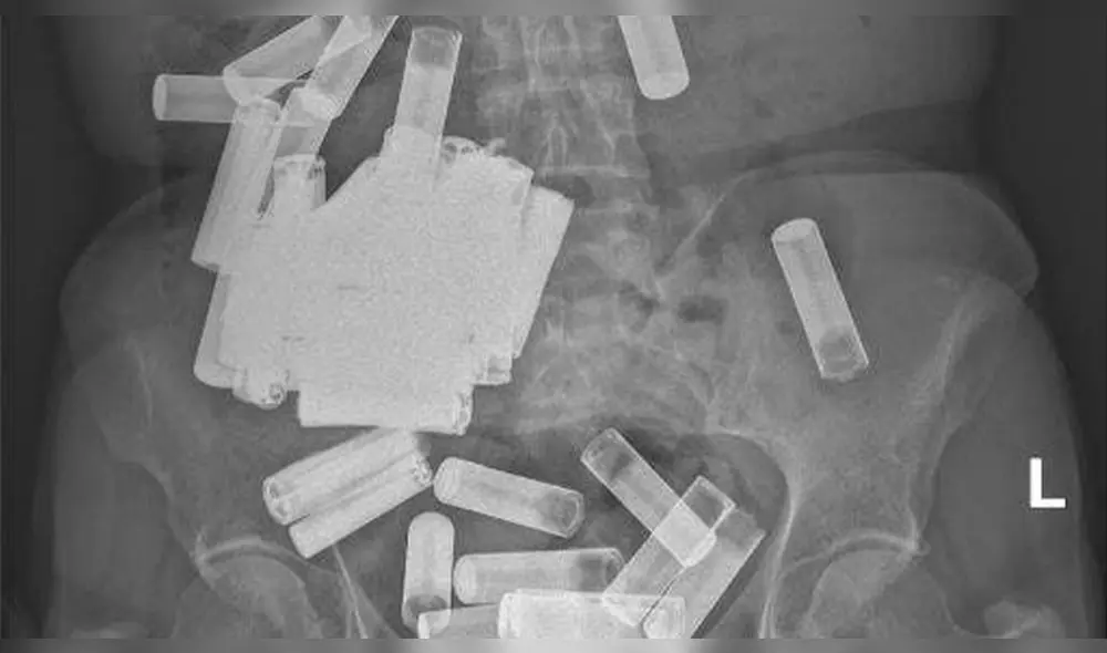 Una radiografía reveló las 55 baterías ingeridas y atascadas en el tracto gastrointestinal de la mujer. Foto: Irish Medical Journal