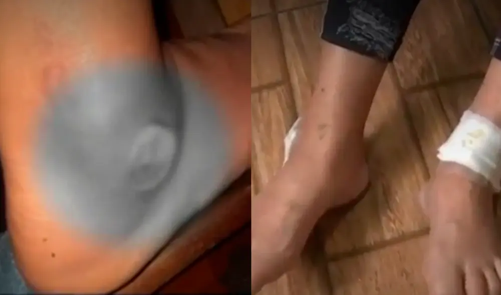 Negligencia médica: mujer que padece de diabetes denuncia a centro de terapias por quemaduras. Foto: composición LR/ATV