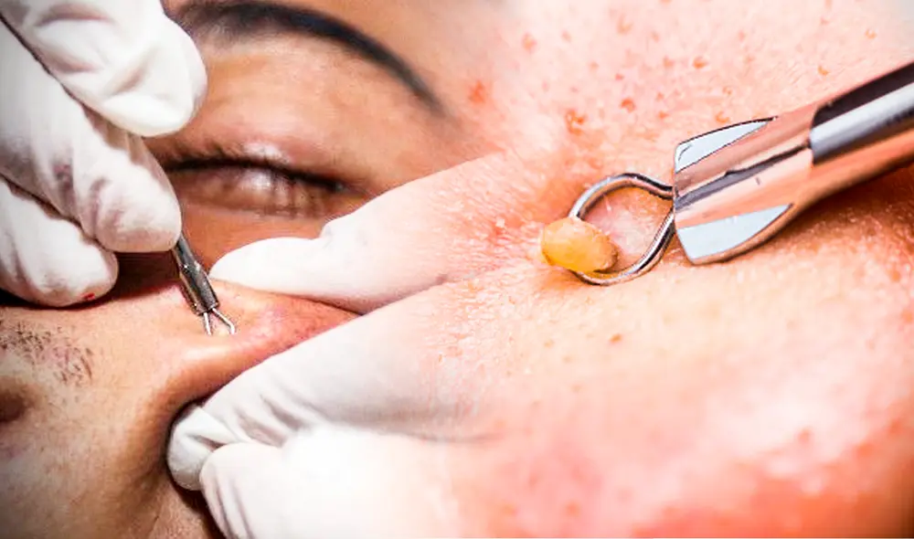 Exprimer granos o espinillas puede causar mucha satisfacción a las personas. Foto: composición LR/hogarmanía/ismorbo Exprimer granos o espinillas puede causar mucha satisfacción a las personas. Foto: composición LR/hogarmanía/ismorbo