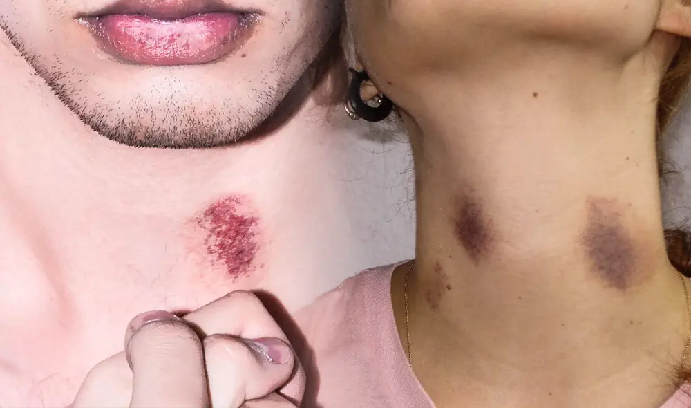 ¿Los chupetones pueden causar la muerte? Conócelo a continuación. Foto: composición LR/Publimetro/El Diario