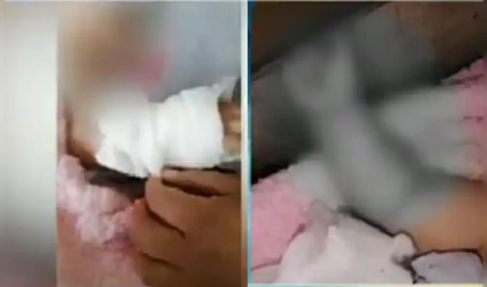 El brazo de la bebé fue quemado luego de un procedimiento radiológico. Foto captura Panamericana