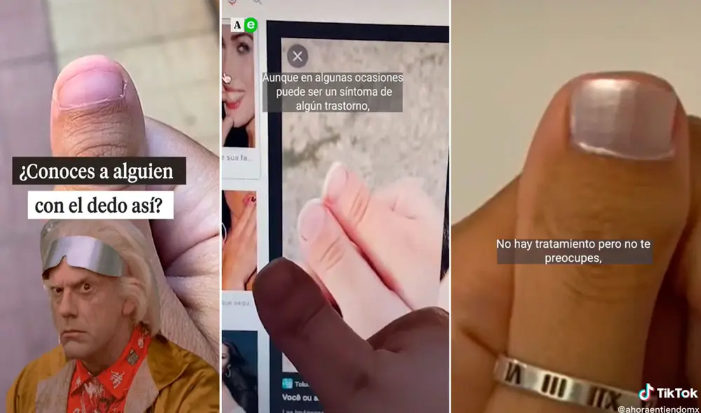 Esta condición afecta a un gran porcentaje de la población y no representa mayores complicaciones. Foto: composición LR/TikTok/@ahoraentiendomx