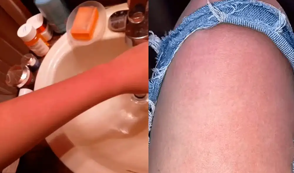 “Simplemente, no parecía real, no pensé que pudieras ser alérgica al agua”, declaró Sadie Tessmer tras ser diagnosticada con urticaria acuagénica. Foto: PA Real Life “Simplemente, no parecía real, no pensé que pudieras ser alérgica al agua”, declaró Sadie Tessmer tras ser diagnosticada con urticaria acuagénica. Foto: PA Real Life