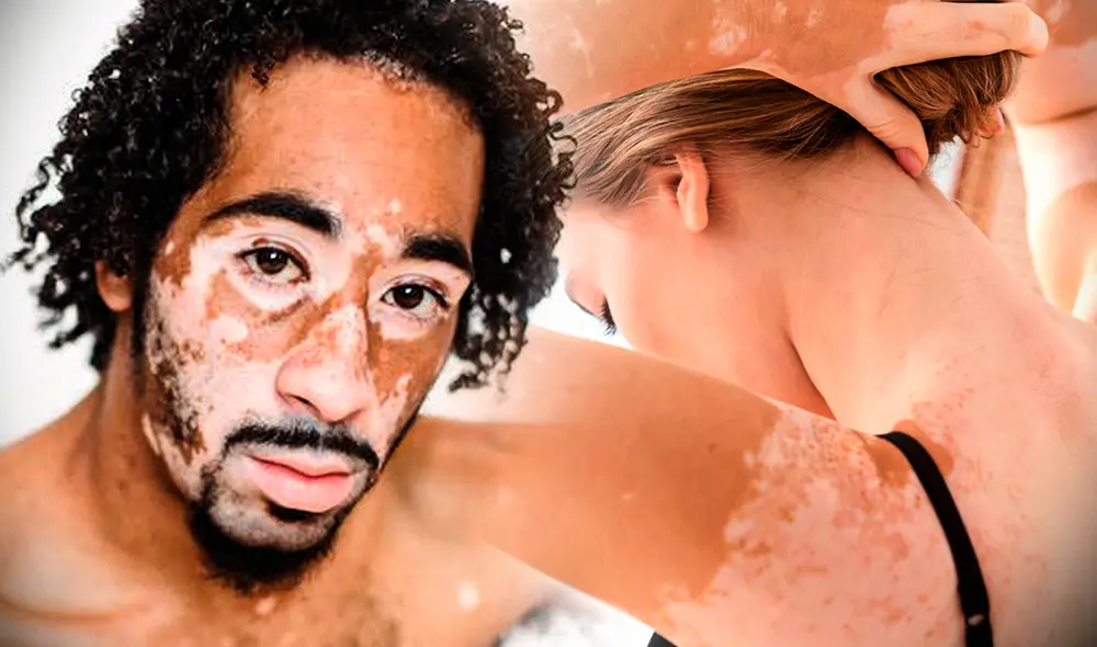 El vitíligo puede extenderse por toda la piel. Foto: composición de Gerson Cardoso/Freepik/Pexels