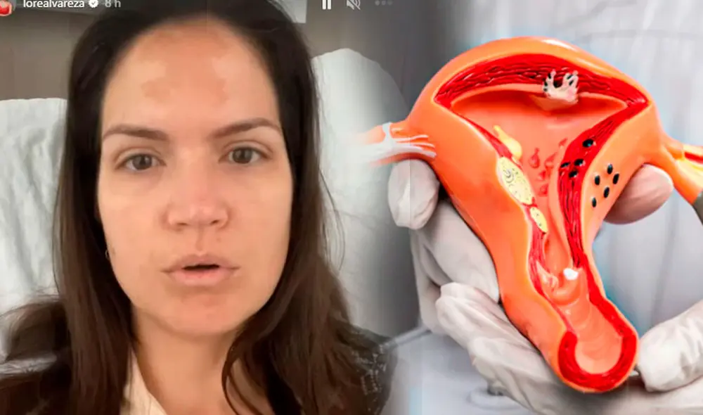 Lorena Álvarez fue sometida a cirugía tras diagnóstico de endometriosis. Foto: composición/LR/captura/Instagram