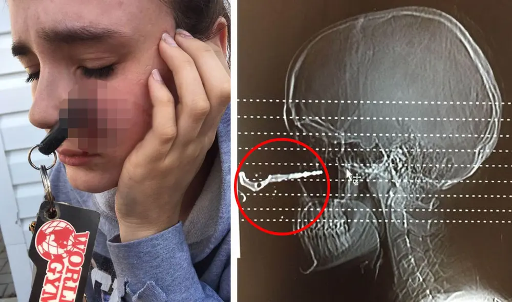 Los médicos quedaron en shock cuando vieron la llave incrustada en el rostro la joven. Foto: composición LR/Kennedy News/Renée Lariviere