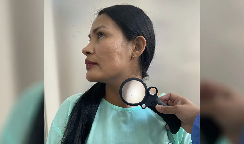 Hacerse un chequeo preventivo de cáncer de piel debe ser política nacional, no se necesita mucha ciencia para detectarlo a tiempo. Foto: Juana Gallegos/La República