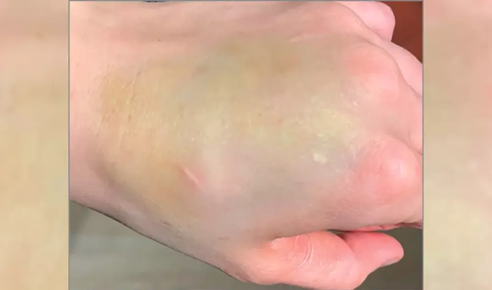 Imagen del tumor en la parte dorsal de la mano. Foto: JAMA Network / American Medical Asociation