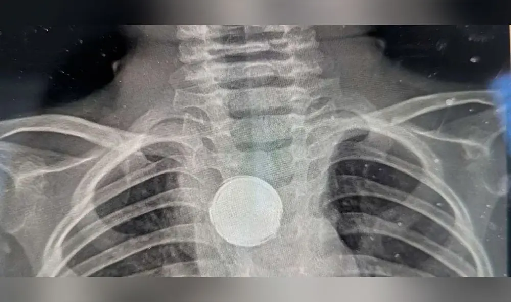Los médicos detectaron que el niño tenía una pila atascada en su esófago gracias a una radiografía. Foto: captura/Clarín