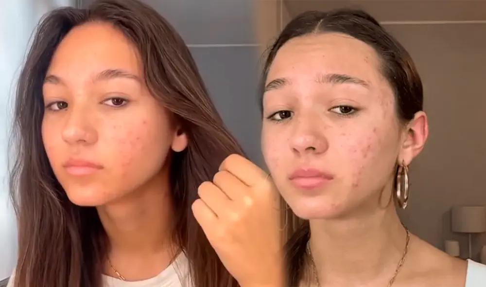 Alexia Barnechea padece de acné crónico. Foto: composición/Alexia Barnechea/Intagram Alexia Barnechea padece de acné crónico. Foto: composición/Alexia Barnechea/Intagram